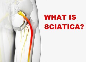 sciatica