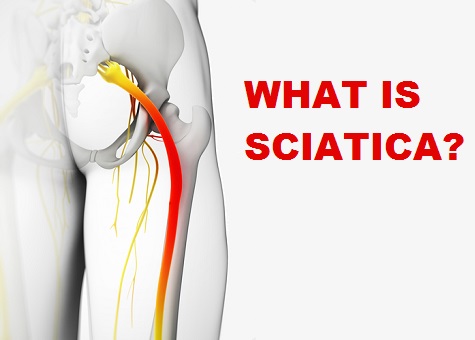 sciatica