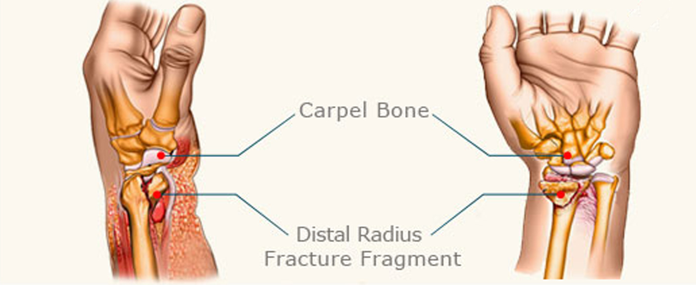 WRIST FRACTURE