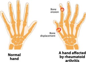 RHEUMATOID ARTHRITIS