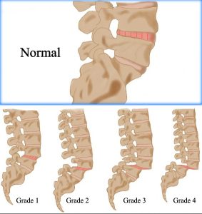 SPONDYLOLISTHESIS