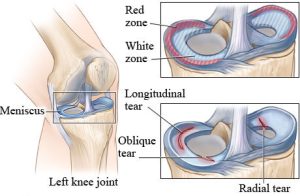 MENISCUS KNEE TEAR