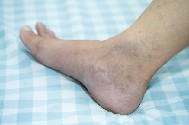 masculin varicose foot