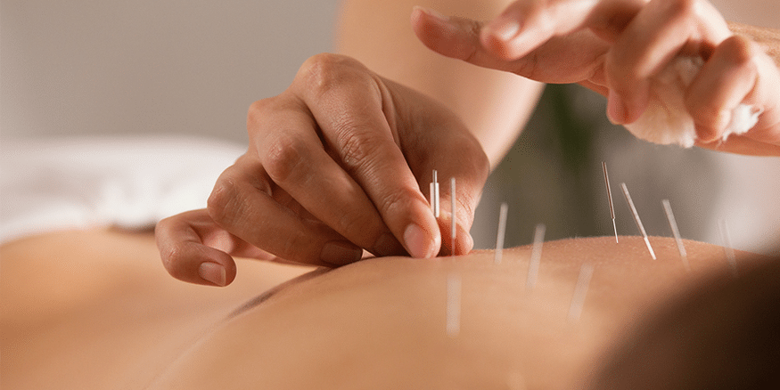 Acupuncture treatment